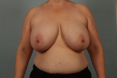 Breast Reduction Before Photo