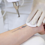 Close-up of laser tattoo removal from woman hand.