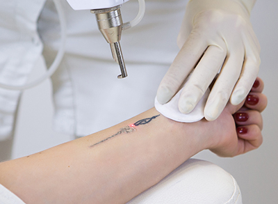 Close-up of laser tattoo removal from woman hand.