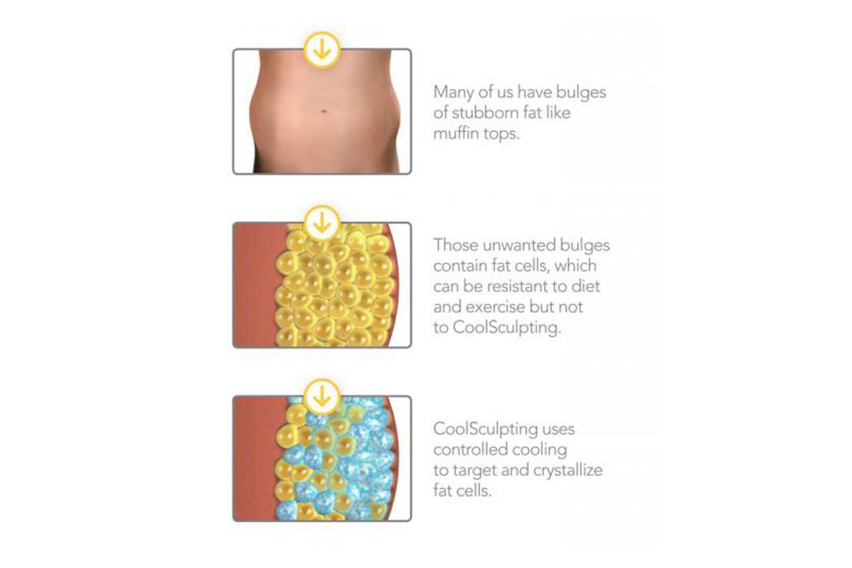 How CoolSculpting Works diagrams part 1