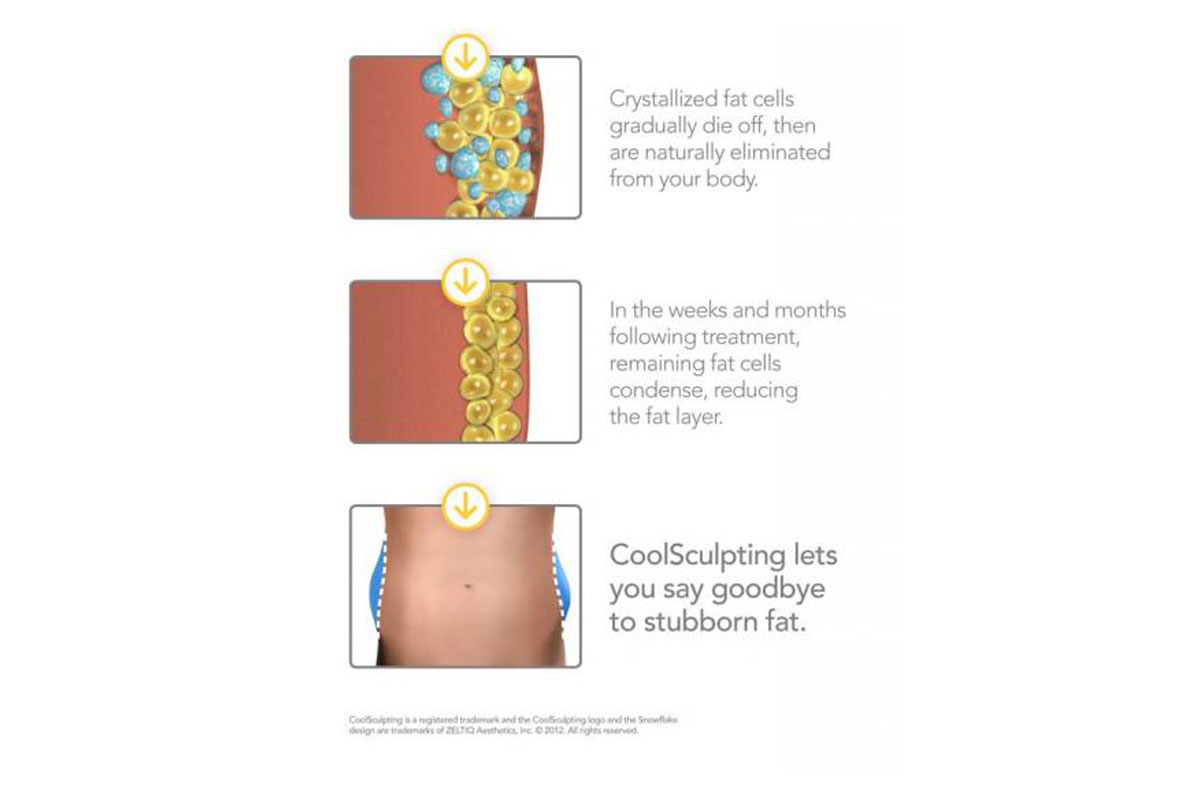 How CoolSculpting Works diagrams part 2