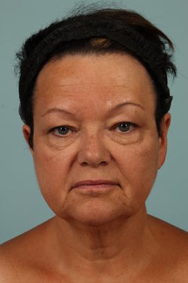 before eyelid surgery in Woodstock, GA