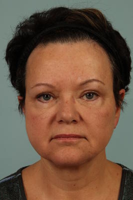 patient results after eyelid surgery in Woodstock, GA