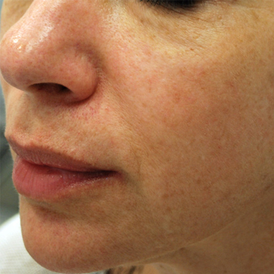 After Morpheus8 in Atlanta