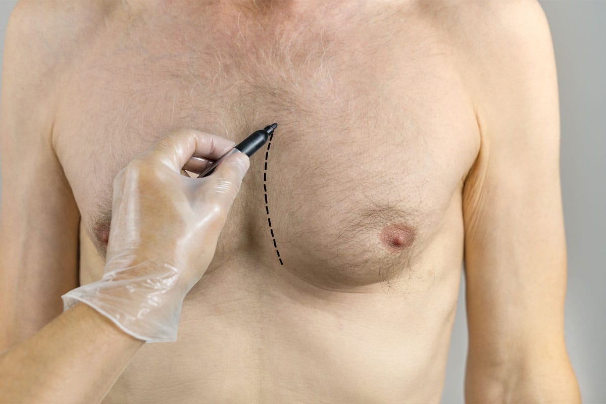 man getting a consultation for gynecomastia surgery in Marietta, GA